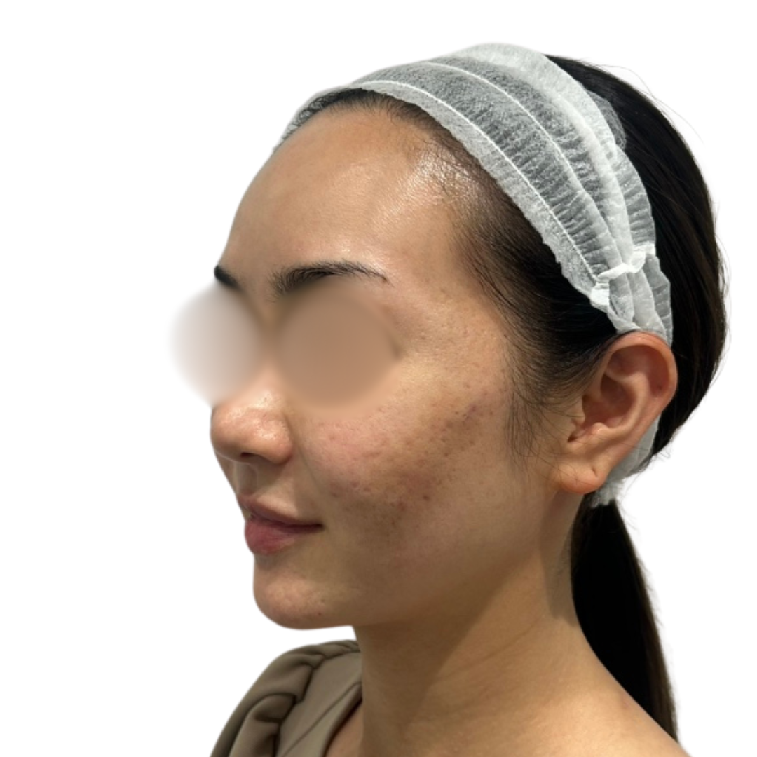 サブシジョン（クレーター治療）